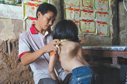 有嚴(yán)重脊椎畸形及胸腔隆突病的李文霞。