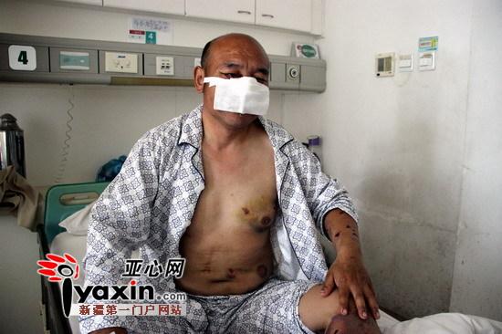 新疆沙灣村民山中撿玉遭棕熊攻擊 鼻子、上嘴唇被咬掉撿回一命（圖）