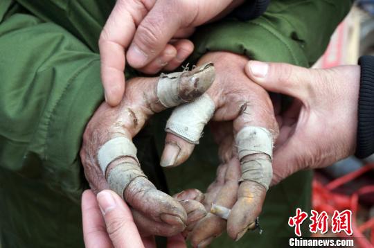 圖為由于常年拾荒，老人雙手布滿傷口。周小云 攝