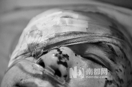 李建新頭部還有被潑硫酸的痕跡，醫(yī)生說被砍傷的右眼已經(jīng)失明。 南都記者 田飛 攝