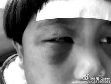 6月2日，網(wǎng)曝渭南市臨渭區(qū)一不滿5歲的女童遭奶奶毆打，眼圈青腫，引起網(wǎng)友關(guān)注，但孩子父母和爺爺均稱是摔倒導(dǎo)致。相關(guān)部門介入調(diào)查發(fā)現(xiàn)確為奶奶毆打所致，鑒于其身體原因已進(jìn)行批評(píng)教育。