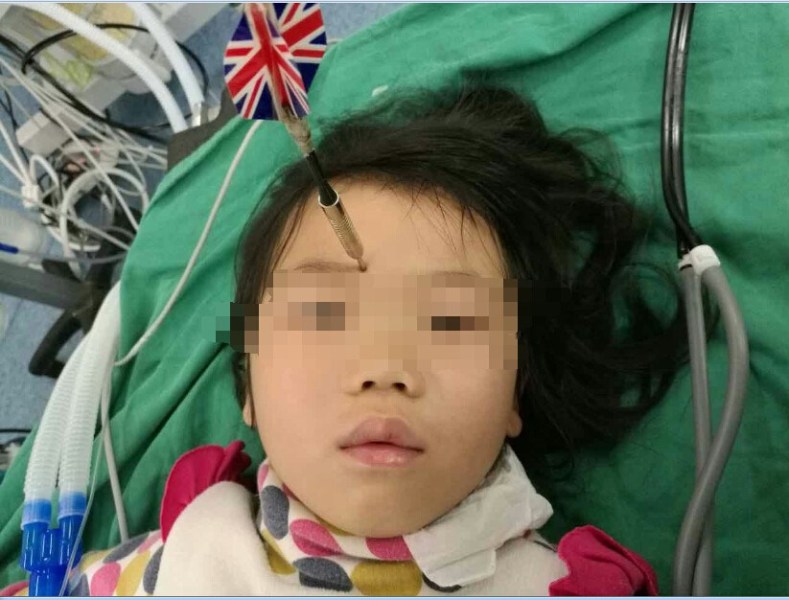 十多公分長(zhǎng)的飛鏢穩(wěn)穩(wěn)地 ” 定 ” 在了一名六歲半的女童額頭上，小青一家人凌晨從長(zhǎng)順趕到貴醫(yī)附院急診室時(shí)，看到如此慘烈的情況，接診醫(yī)生都嚇了一跳。詳細(xì)詢問下得知，原來(lái)是七歲的哥哥和六歲半的表妹在玩耍時(shí)，哥哥不慎將路邊撿來(lái)的真飛鏢扎到了妹妹的額頭上。