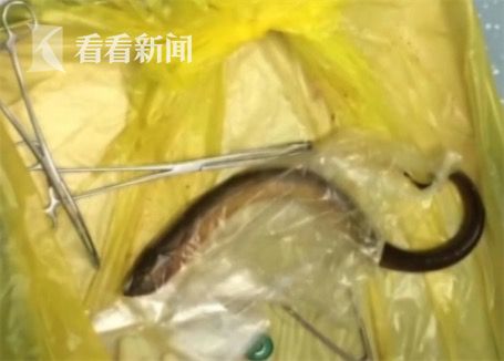 黃鱔從肛門鉆進肚子 男子被送醫(yī)不愿多談事情經過