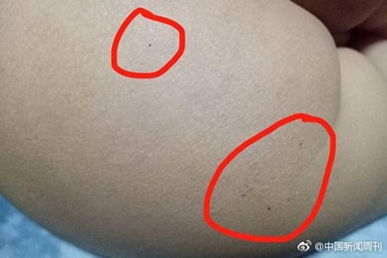 據(jù)多名紅黃藍(lán)(新天地分園)家長(zhǎng)反映，孩子腿部、屁股、腋下出現(xiàn)針眼。