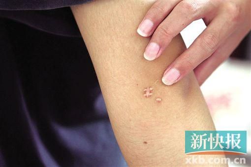取出針后李星兒手臂留下了傷口。新快報記者 張國鋒/攝