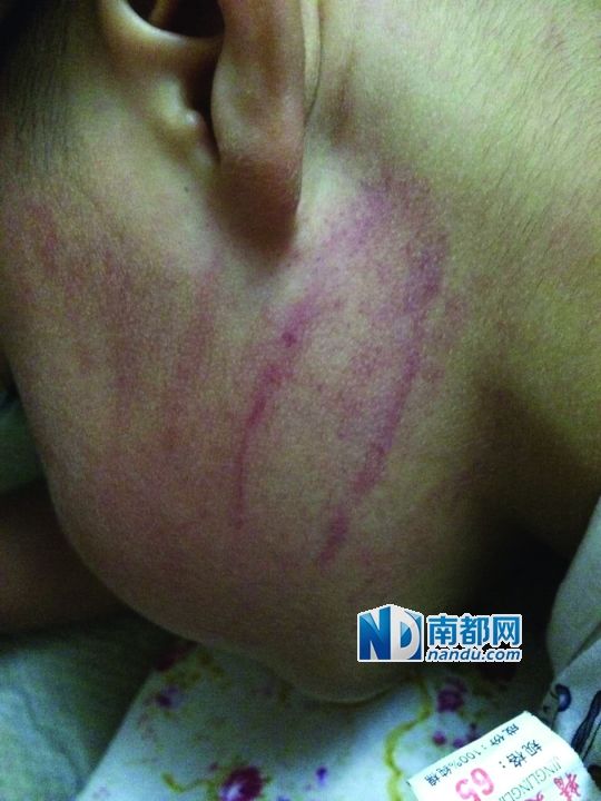 小逸臉上淤痕清晰可見(jiàn)。