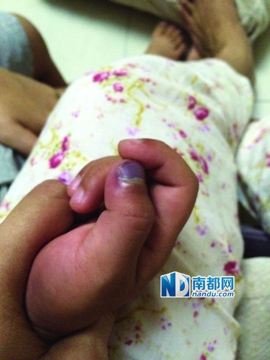 小逸手指被夾傷。