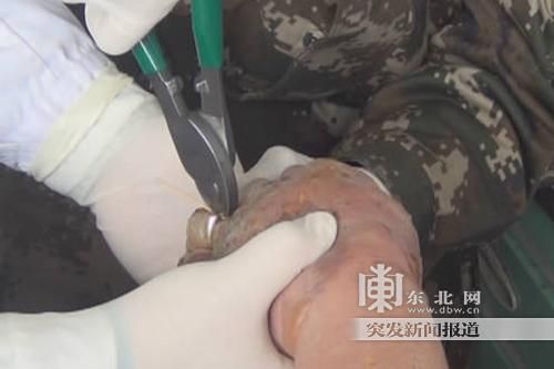 正在拆除戒指。