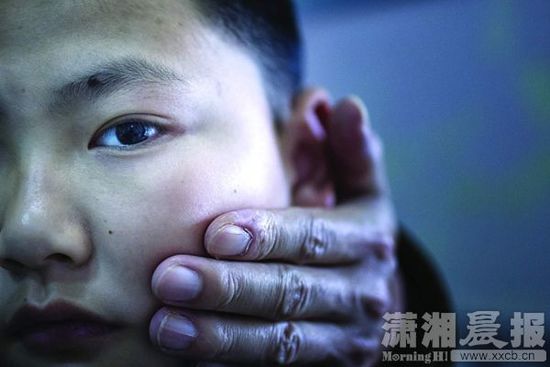 1月13日，小玨的父親心疼地摸著兒子的臉。