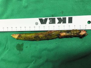 插入男子腦內(nèi)的樹枝。